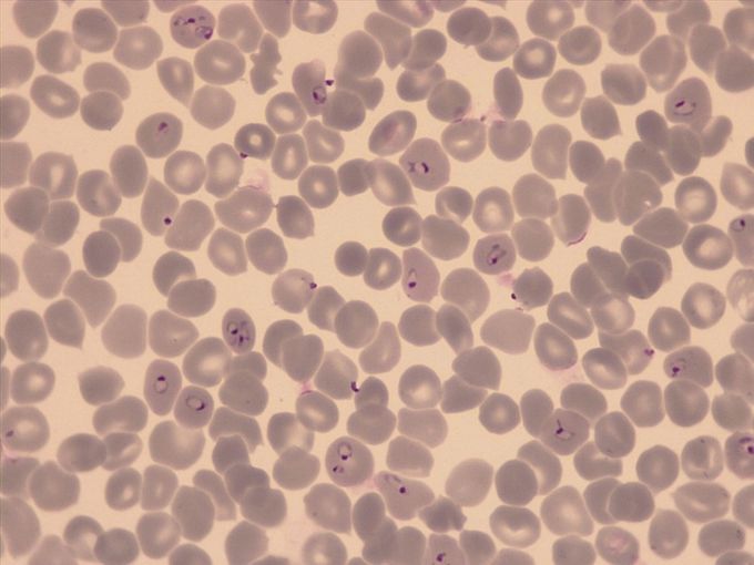 Red blood cells infected with Plasmodium falciparum (Photo credit: Armin Passecker)